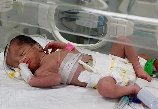 معجزانہ طور پر پیدا ہونے والی بچی بھی دم توڑ گئی